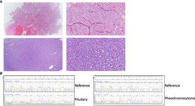 Case report: Two sisters with a germline CHEK2 variant and distinct endocrine neoplasias